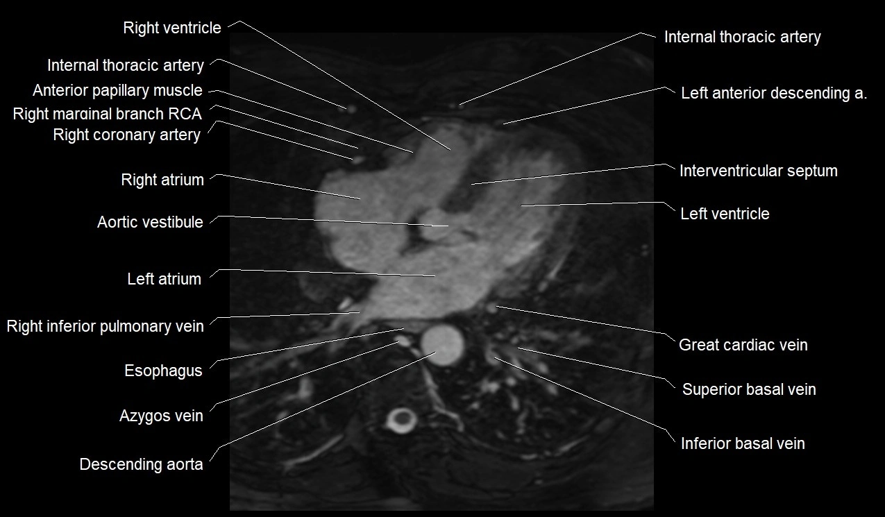 MRI heart coronary arteries and coronary veins anatomy axial image 27.webp